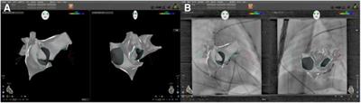 A novel image integration technology mapping system significantly reduces radiation exposure during ablation for a wide spectrum of tachyarrhythmias in children